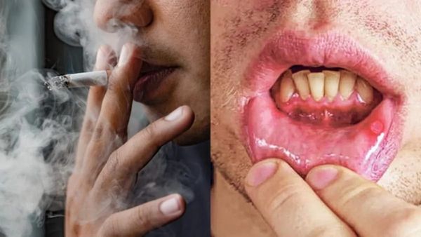 Researchers identify key genetic factors causing oral cancer early among Indian tobacco chewers