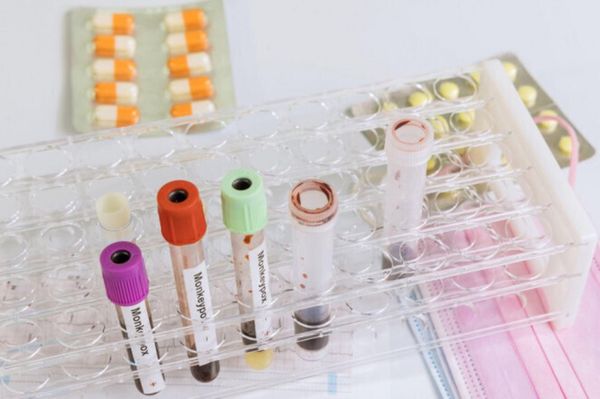 Három új majomhimlős esetet azonosítottak Romániában