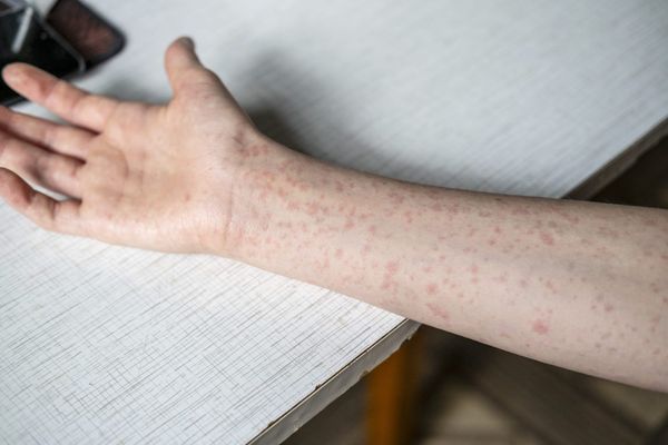 Measles Is Making a Comeback in Texas, Thanks to Anti-Vaxxers
