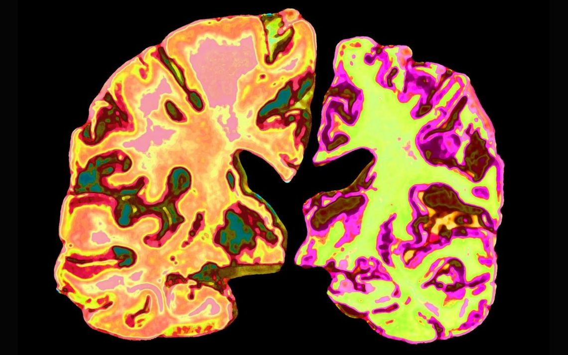Should we all be taking low doses of lithium to prevent Alzheimer’s?