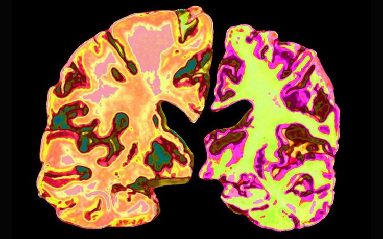 Should we all be taking low doses of lithium to prevent Alzheimer’s?