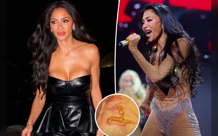 Nicole Scherzinger shows off gruesome injury after ‘boiling water’ fell on her leg 1 hour before concert