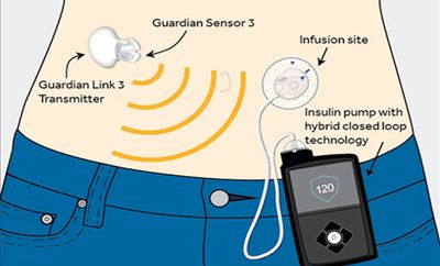First ‘Artificial Pancreas’ Comes to Market