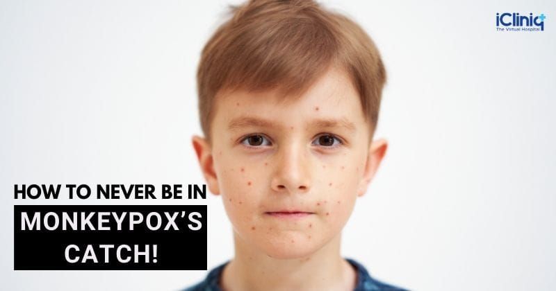 How to Never Be In Monkeypox’s Catch!