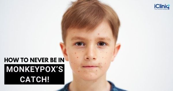 How to Never Be In Monkeypox’s Catch!