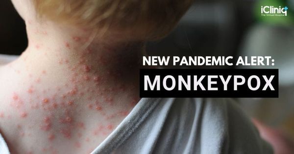 New Pandemic Alert: Monkeypox