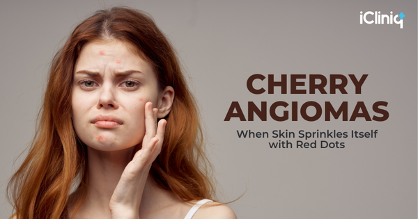 Cherry Angiomas: When Skin Sprinkles Itself with Red Dots