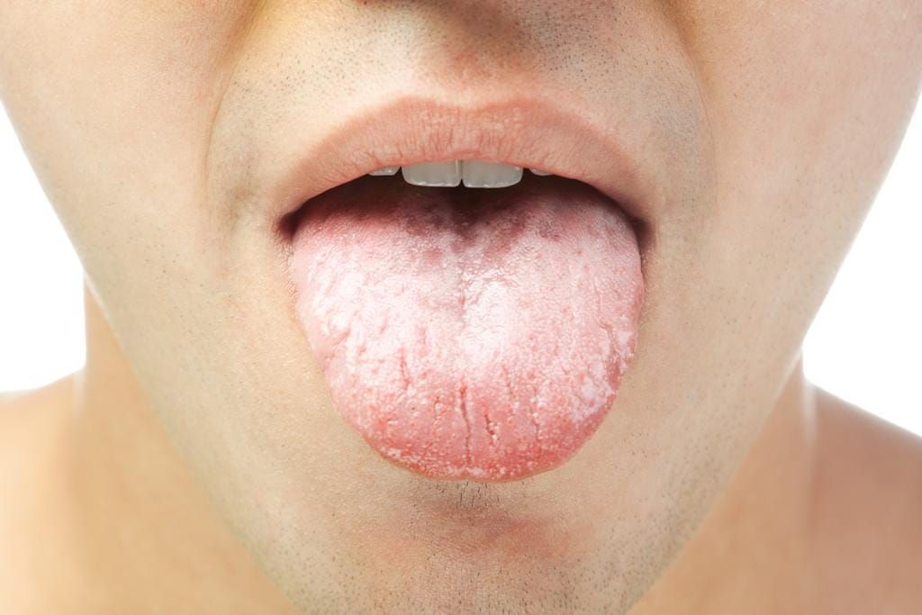 Qué revela la lengua sobre tu salud: señales que pueden indicar anemia, diabetes o cáncer