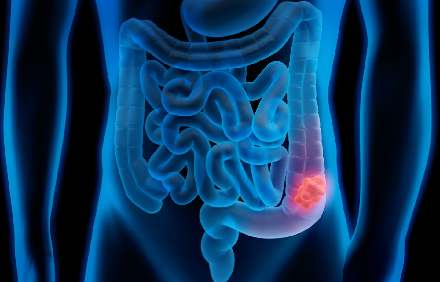 Descubren cómo el cáncer de colon altera sus genes para hacer metástasis y engañar las defensas del cuerpo