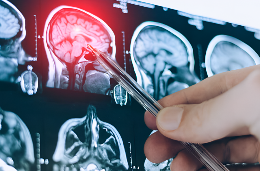 El Hospital Italiano en Córdoba realiza con éxito un implante neurovascular para tratar un aneurisma cerebral