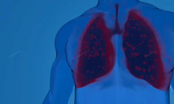 Innsbruck Tıp Üniversitesi, Akciğer Kanserine Karşı Yeni Radyofarmasötik Geliştirdi