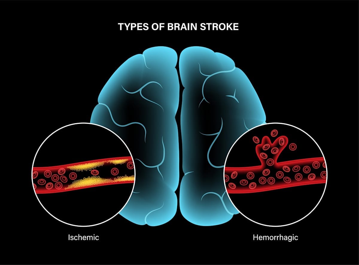 Illustration showing ishemic and hemorrhagic brain strokes