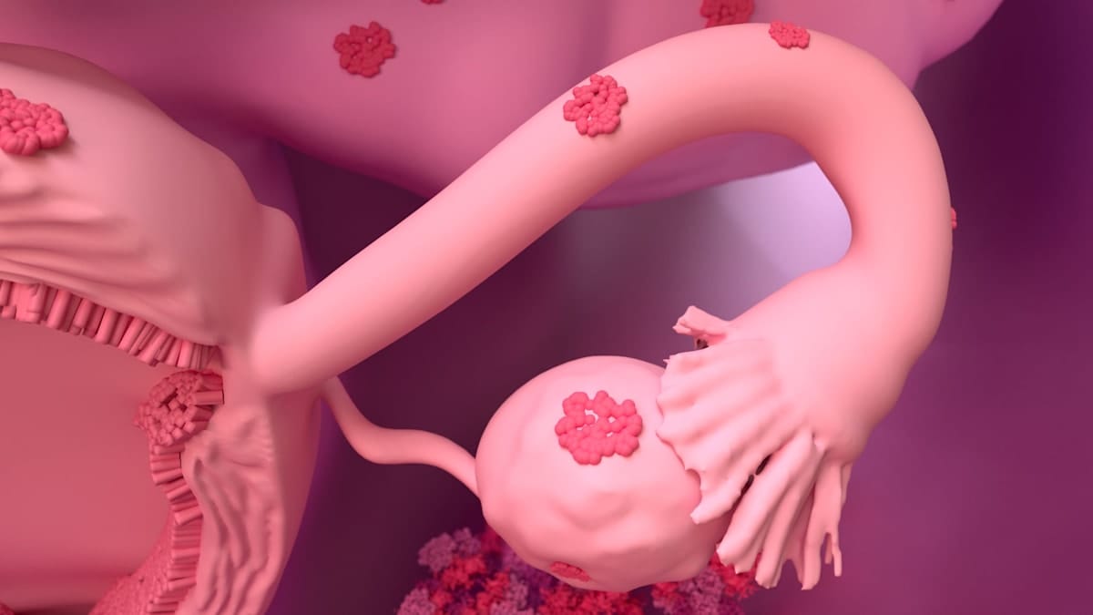 Digital rendering of endometriosis on the female reproductive system