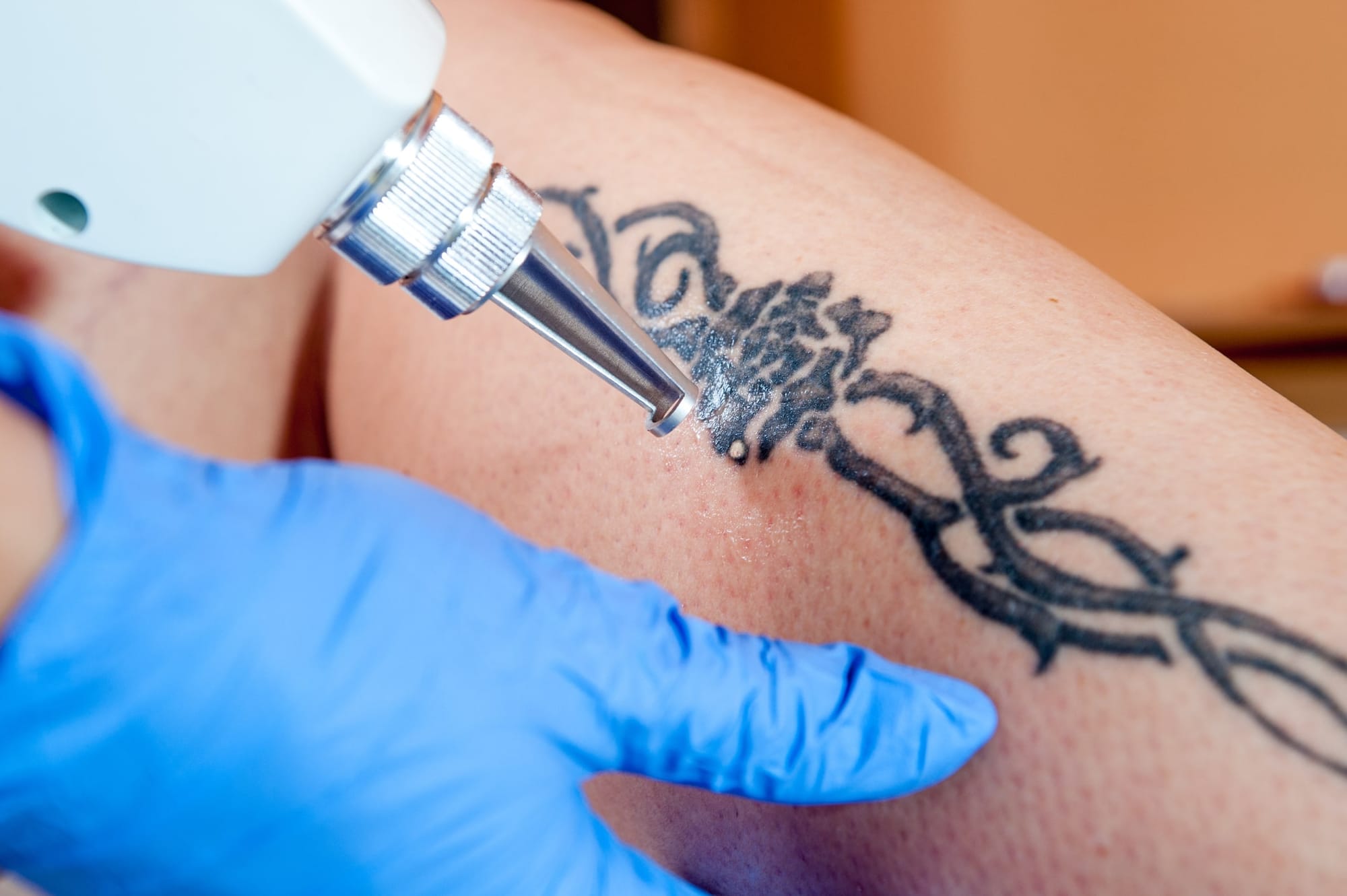 The naked truth about tattoo removal