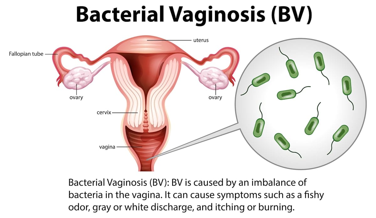 Graphic explaining bacterial vaginosis