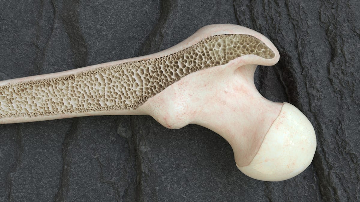 osteoporosis thigh bones from the inside 