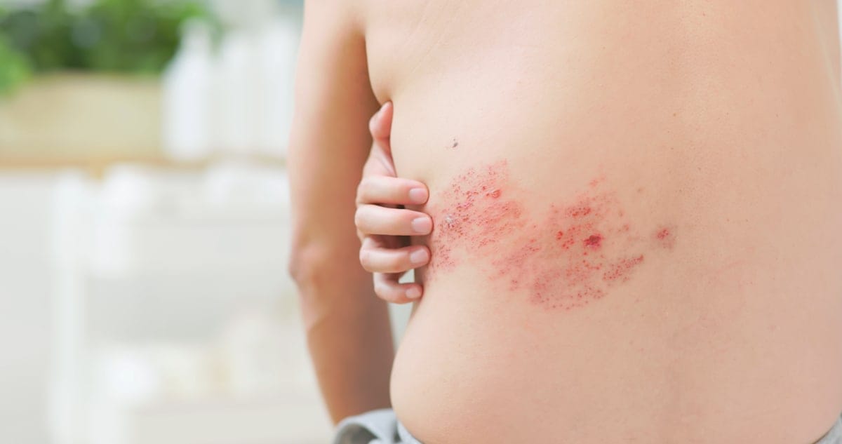 Shingles rash on a person