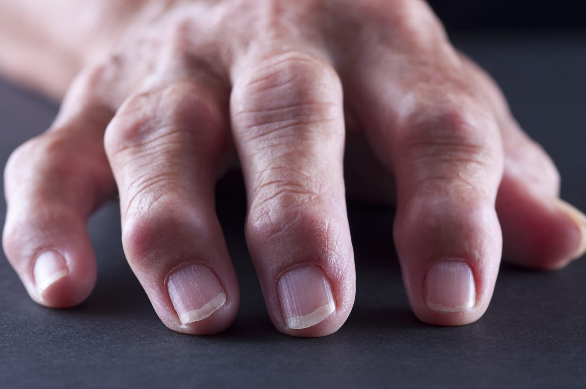 New research has found an existing drug could help many people with painful hand osteoarthritis