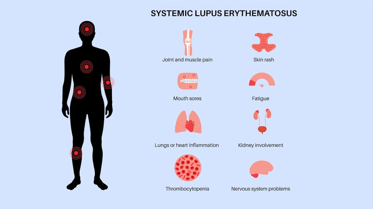 Lupus symptoms chart