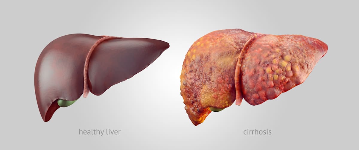 illustration of comparsion of healthy and sick (cirrhosis) human liver