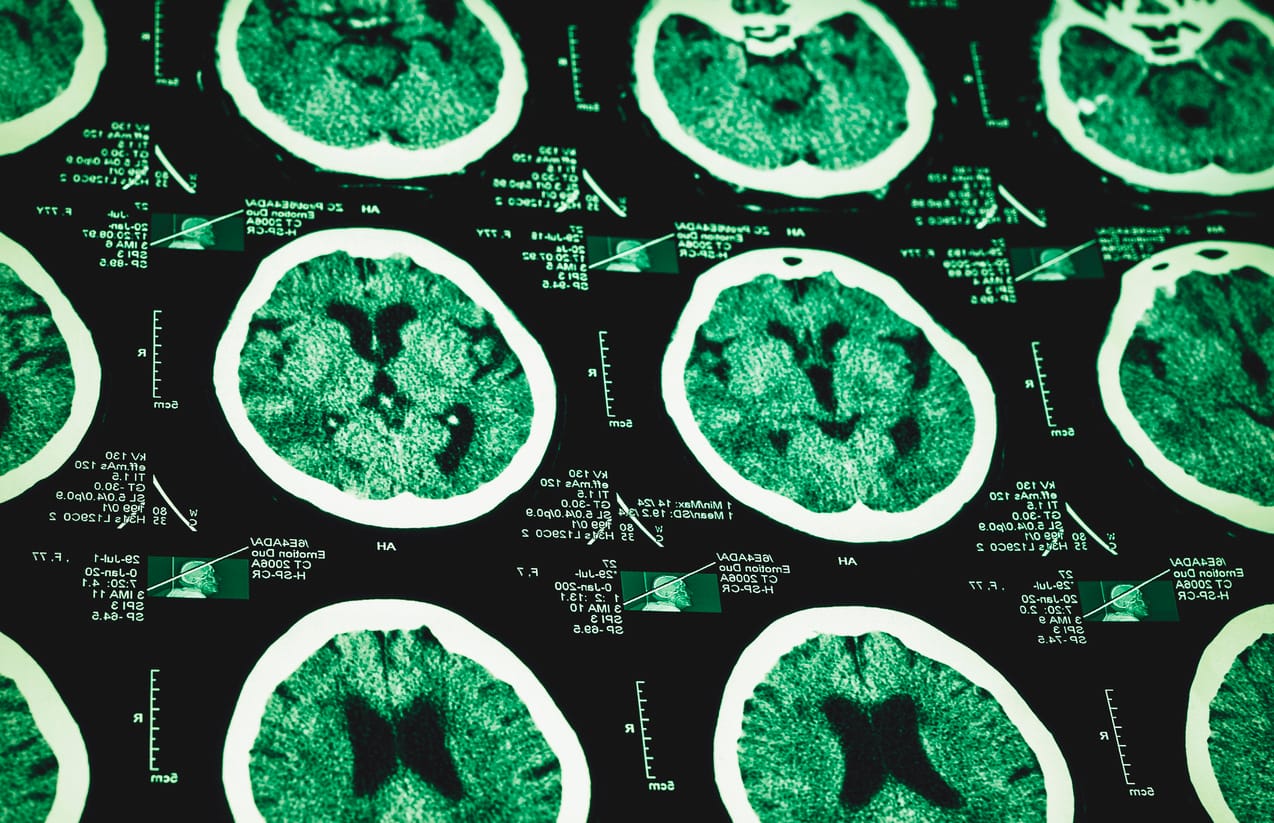 The jury's in on acquired brain injury rehabilitation