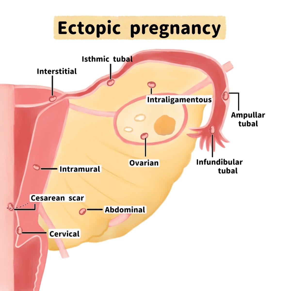 Illustration of ectopic pregnancy locations