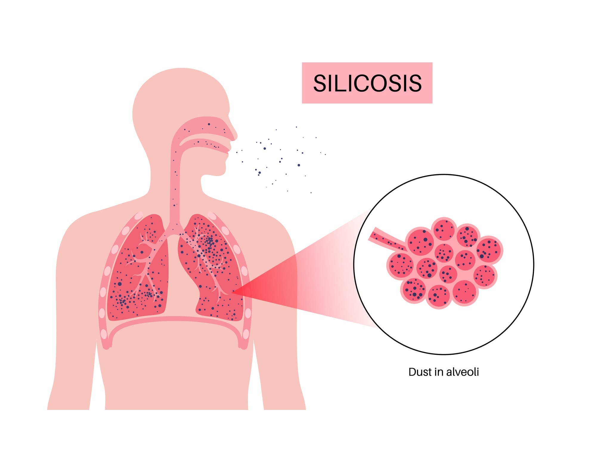 Breathing life into silicosis research