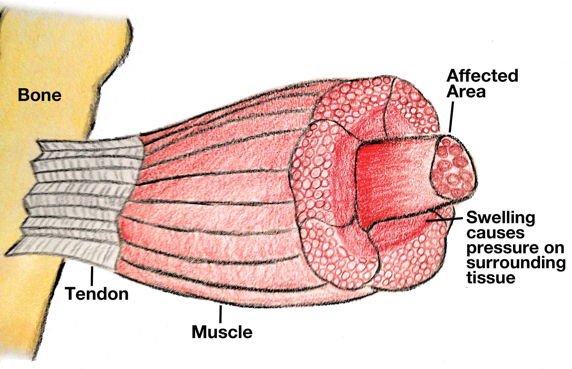 Diagram depicting compartment syndrome in a leg