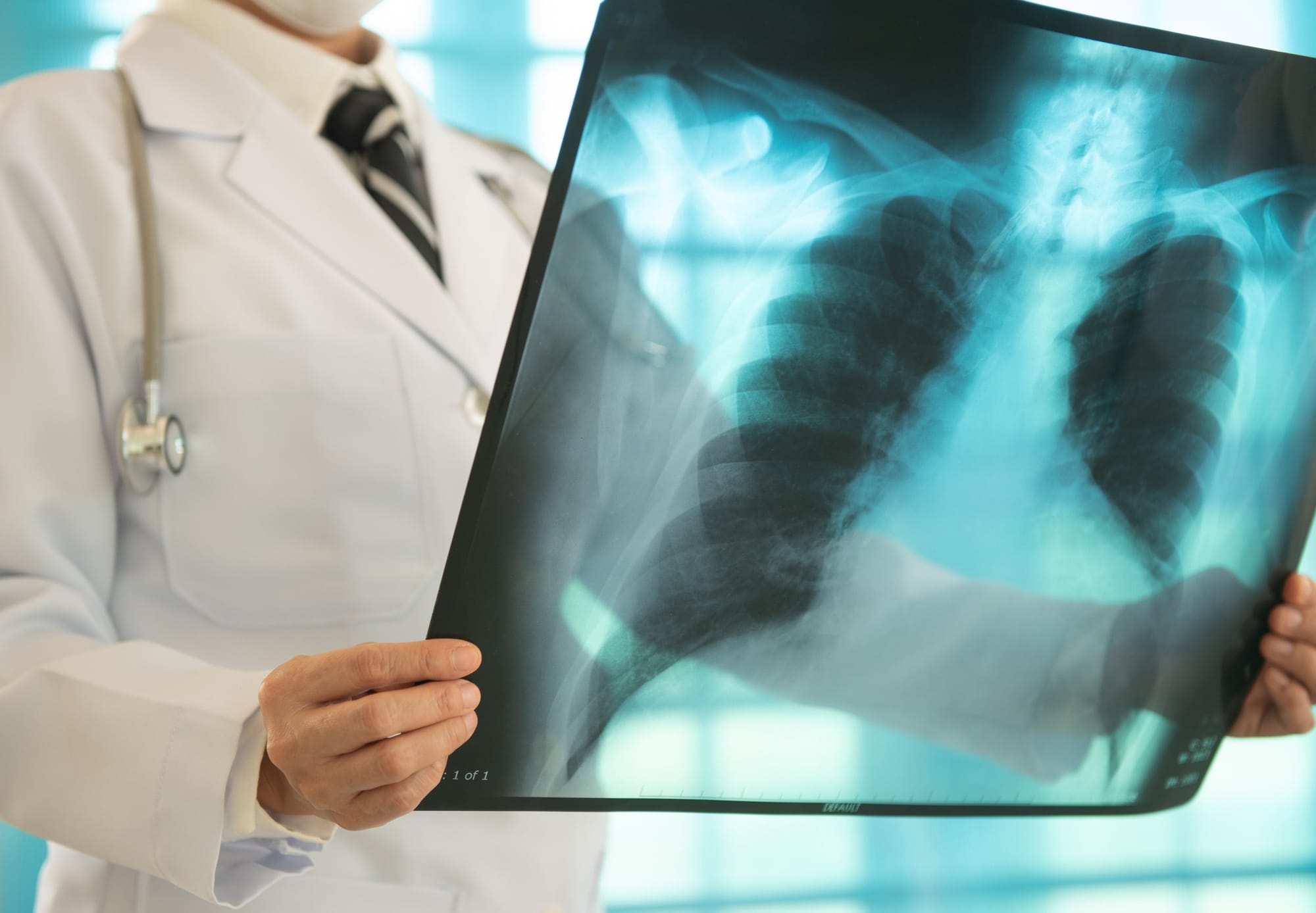 Doctor looking at an X-ray of a person's lungs.