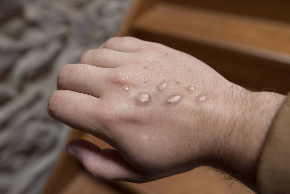 Monkeypox alarm as cases grow outside Africa, but what exactly is it? post image
