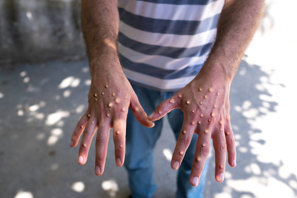 Could monkeypox become the next global pandemic? post image