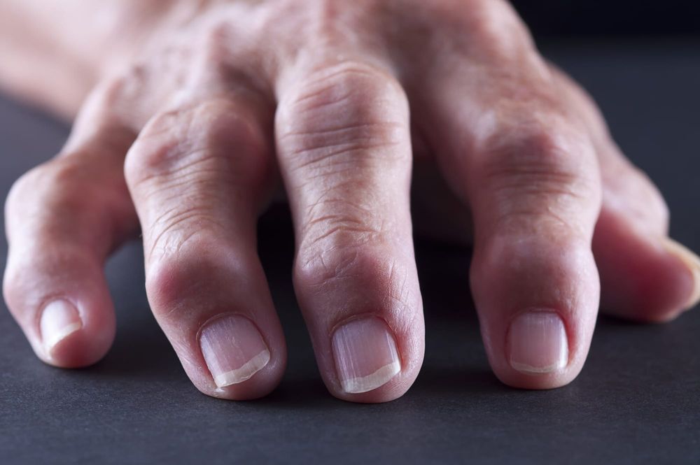 New research has found an existing drug could help many people with painful hand osteoarthritis post image