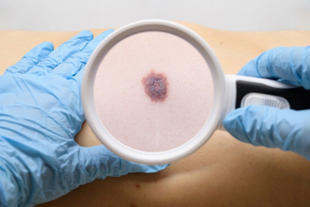 The bigger picture: Balancing innovation and evidence in the fight against melanoma post image