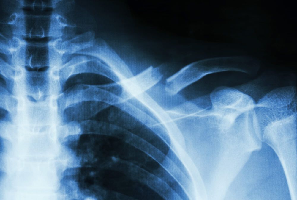 The brittle truth about broken bones, and the better-healing breakthrough post image