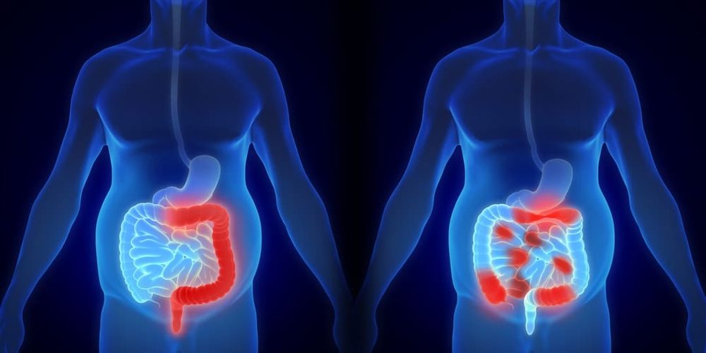 IBD: Virtual clinics are improving patient care and therapy outcomes post image