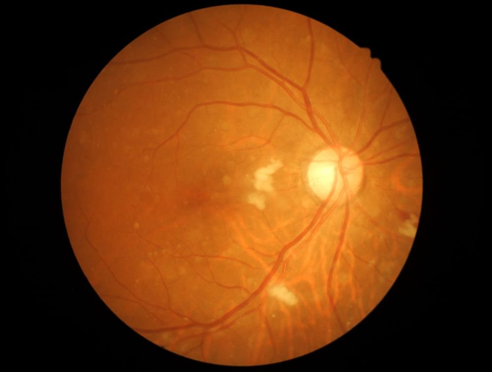 Work on diabetes-related retina disease may save the sight of premature babies post image