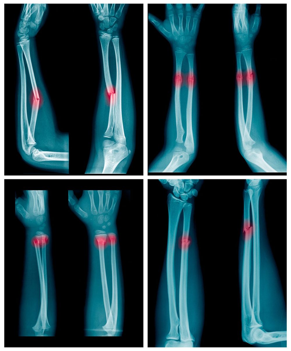 Abuse or just an accident? Decoding skeletal trauma in children post image