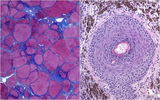Cirrhosis of the liver and Melanoma