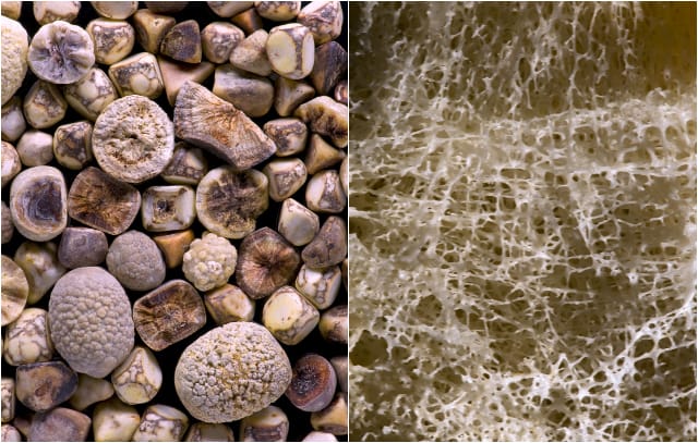 Gallstones and Osteoporosis