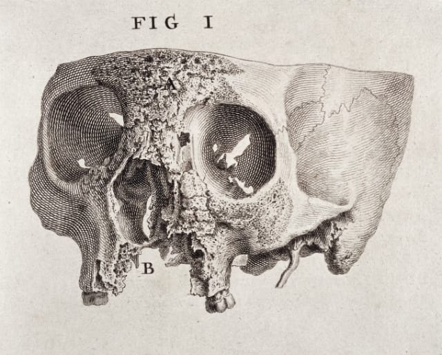 William Cheselden, engraving showing the diseased part of a human skull. From "Osteographia, or the anatomy of the bones" (1733)