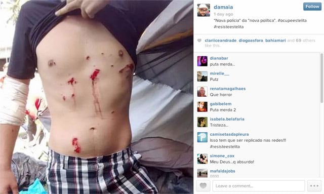 A protestor at #OcupeEstelita shows his injuries from rubber bullets (via @damaia on Instagram)