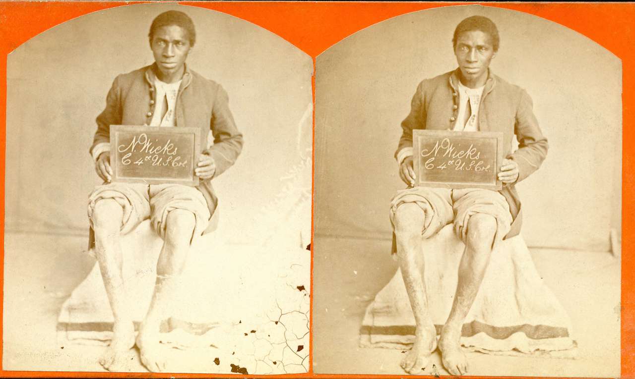 Neil Wicks, "Scabies of both legs, PVT, Company C, 4th US Colored Troops," stereograph (via National Museum of Health and Medicine)