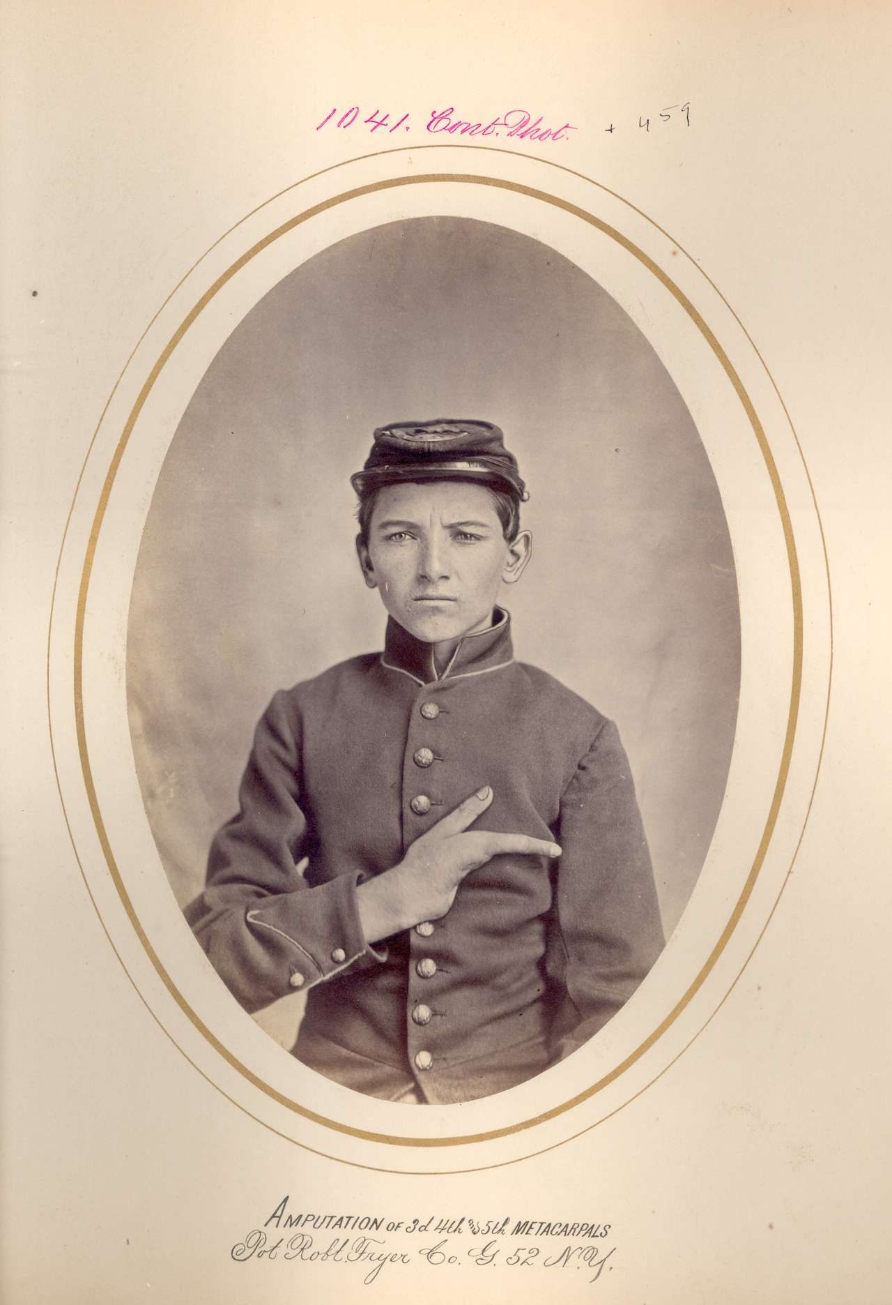 Robert Fryer. Amputation of third, fourth, and fifth metacarpals. PVT, Company G, 52nd New York Volunteers. Wounded March 25, 1865 at the Battle of Hatcher's Run, Virginia (via National Museum of Health and Medicine)