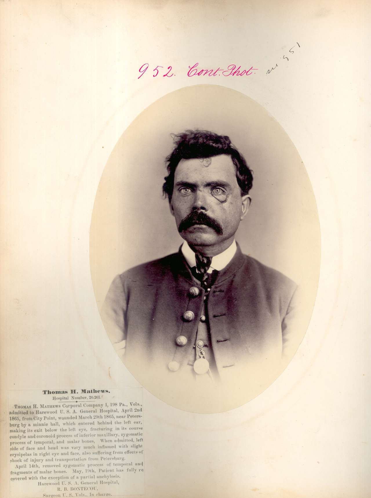 Thomas H. Mathews. Gunshot fracture of inferior maxilla & zygoma. CPL, Company I, 198th Pennsylvania Volunteers. Wounded March 29, 1865 at the Battle of Petersburg. (via National Museum of Health and Medicine)