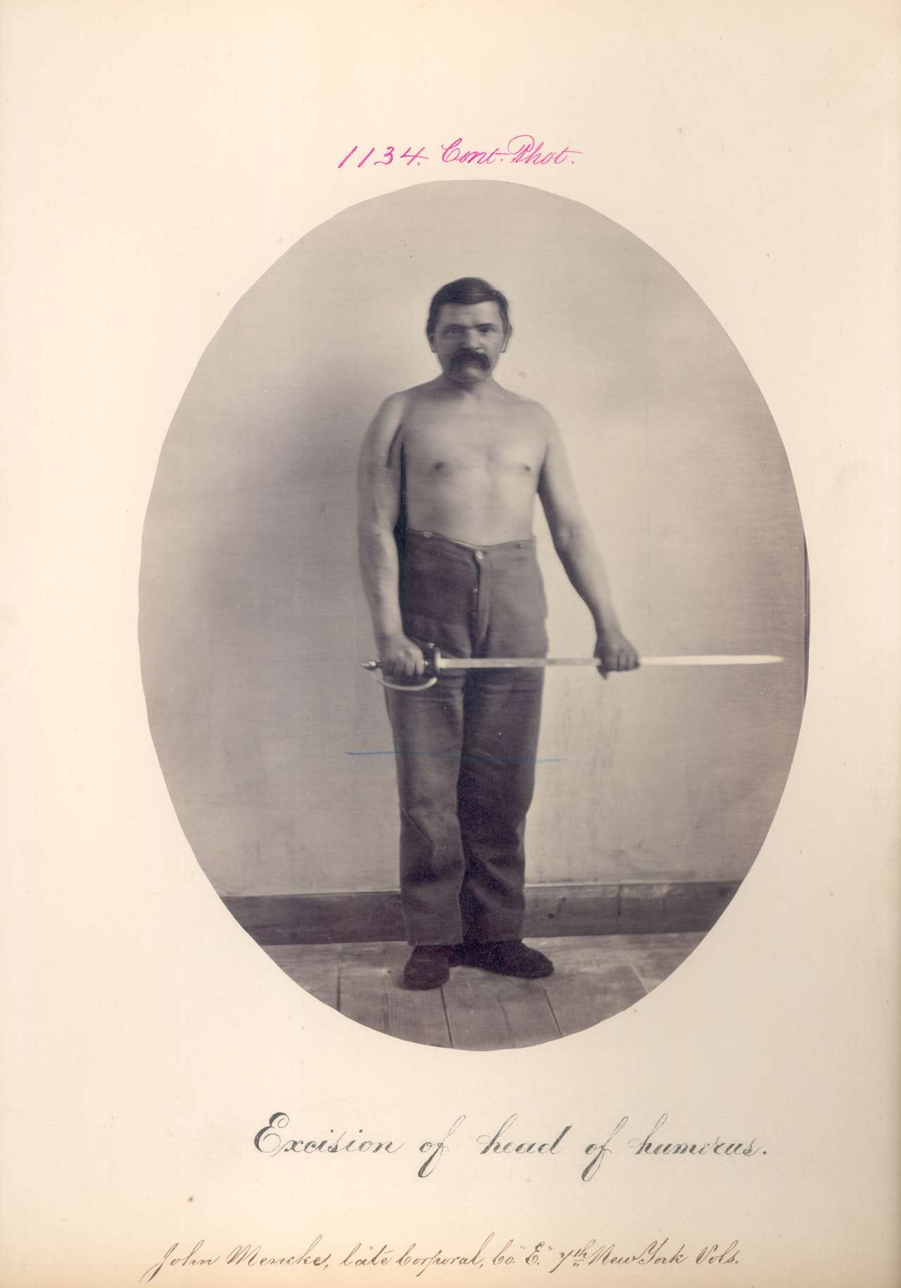 John Mencke, Excision of head of humerus. CPL, Company E, 7th New York Volunteers. (1866) (via National Museum of Health and Medicine)