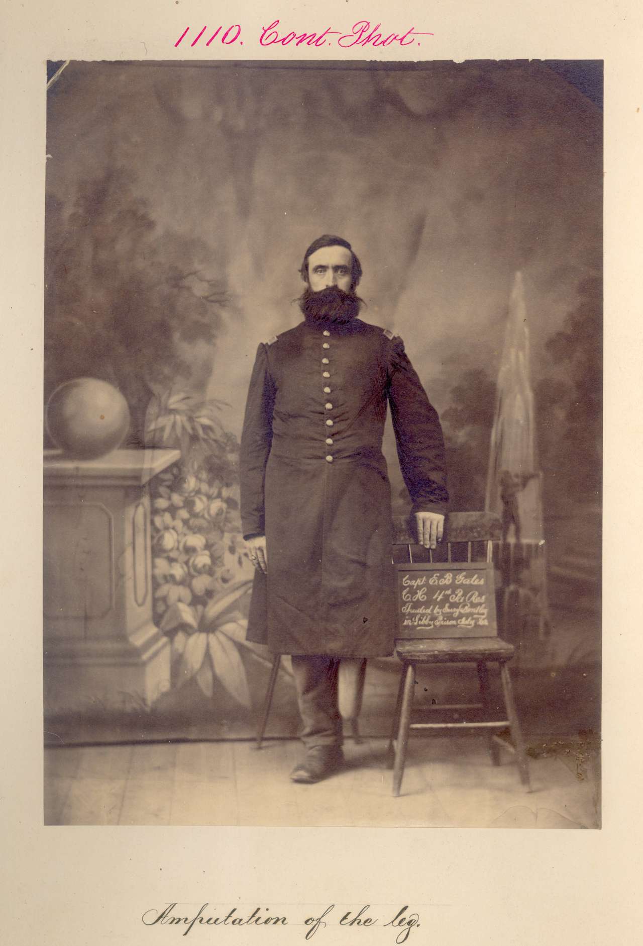 E. B. Gates. Amputation of the leg. CAPT, Company H, 4th Pennsylvania Reserves. (via National Museum of Health and Medicine)