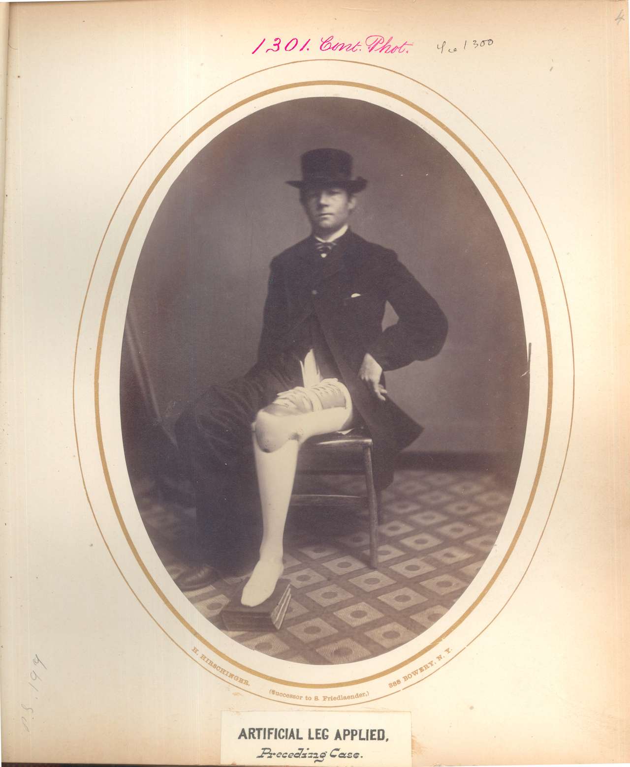 David D. Cole. Artifical leg applied. CPL, Company A, 2nd New York Cavalry. Injured April 2, 1865 at the Battle of Amelia Court House. (via National Museum of Health and Medicine)