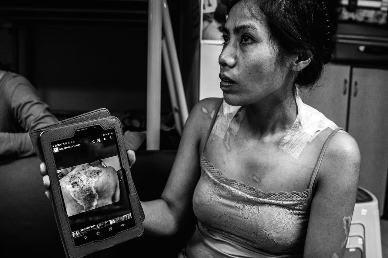 900 square feet of hidden hope. One resident of Bethune House is Shirley showing Images of her burns. Treatment required hospitalization.  Her employer refused doctor-recommended sick leave for recuperation, and terminated Shirley's employment contract which is against Hong Kong labor law. Bethune House, Hong Kong, July 2, 2014. © Xyza Cruz Bacani.  