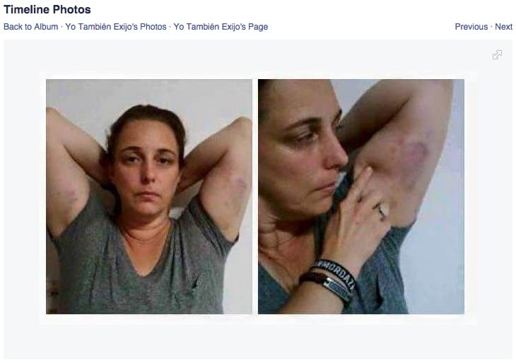 Artist Tania Bruguera showing the bruises she received at the hands of Cuban police during her most recent arrest (screenshot via Facebook)
