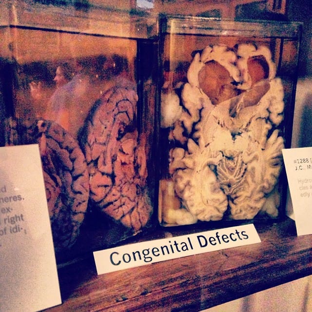 Brain tissue in jars at the Indiana Medical History Museum (photo by @robinwaites/Instagram)
